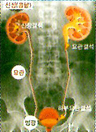요로결석모식도